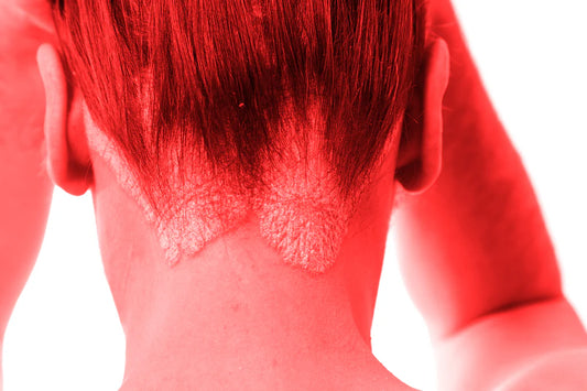 Red Light Therapy for the treatment of Psoriasis