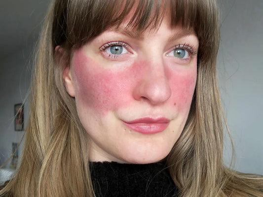 Red light therapy for Rosacea