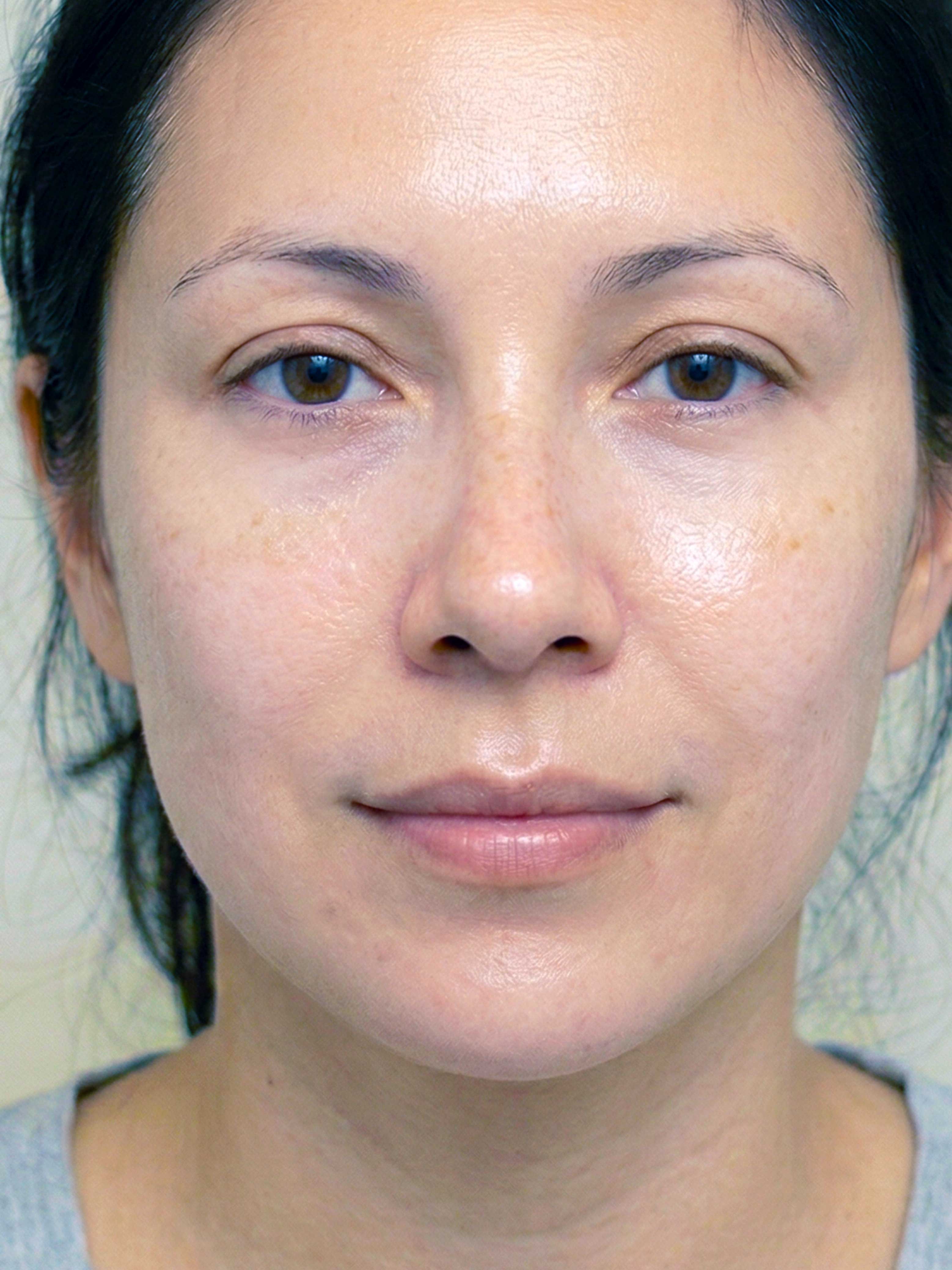 AFTER Light therapy for hyper pigmentation