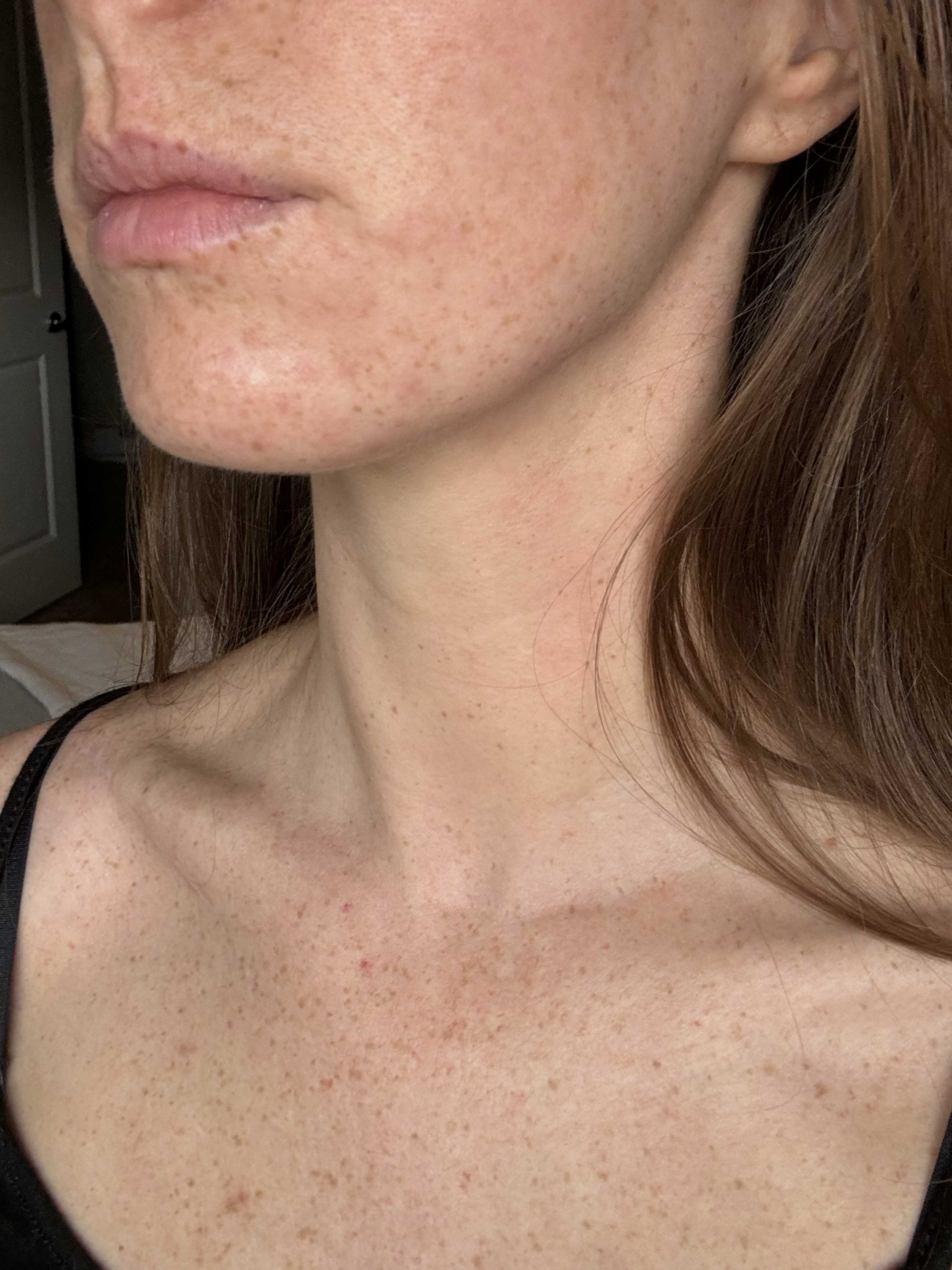 What is the best LED light therapy mask for acne and spots