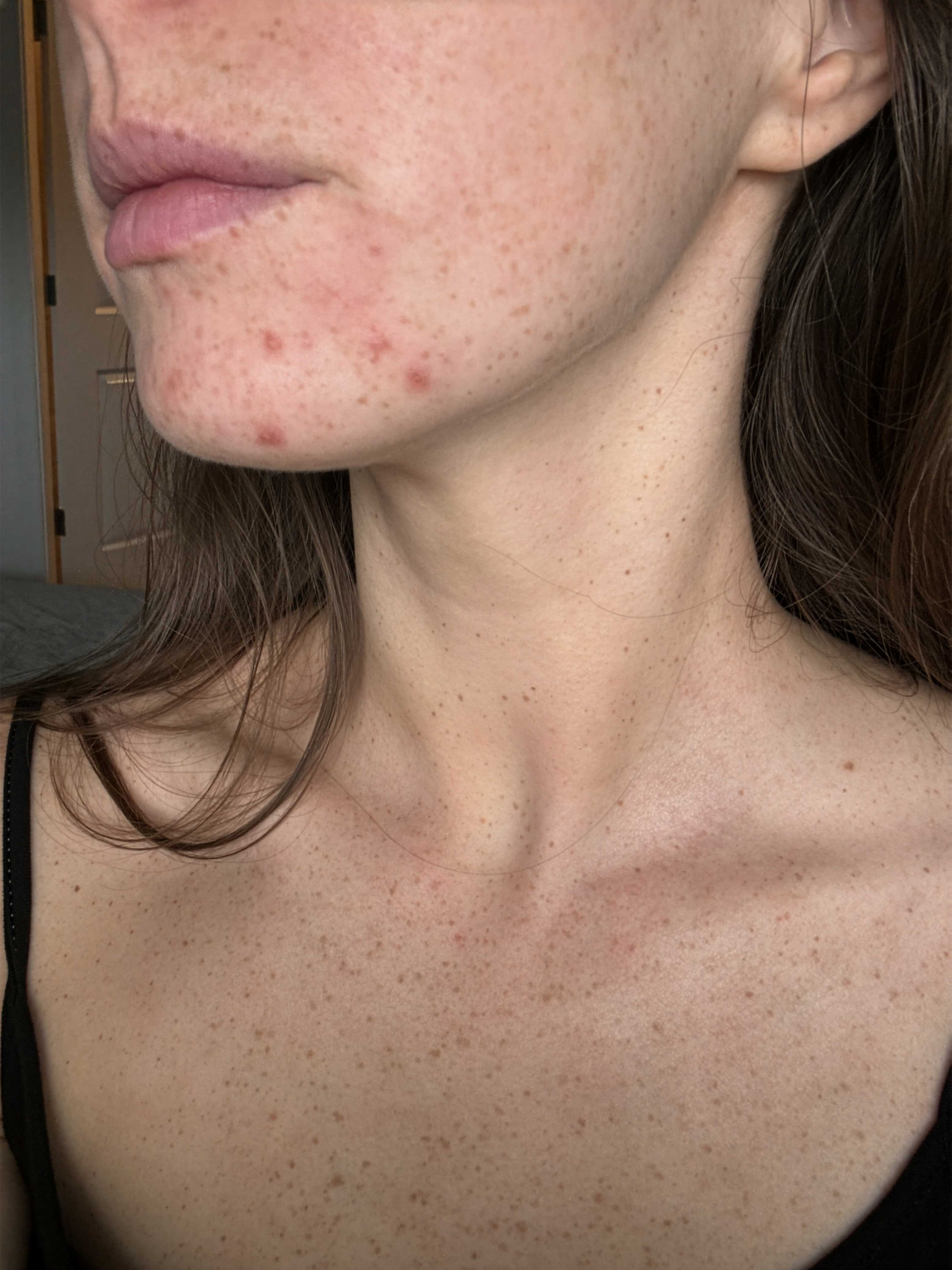 What is the best LED light therapy mask for spots and acne
